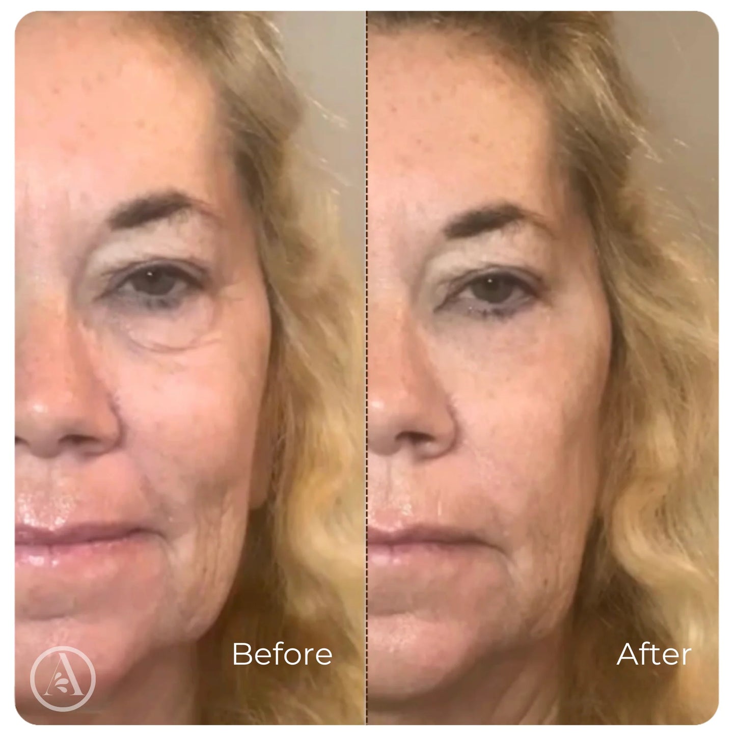 Sephorin™ Peptide Lifting Ampoule
