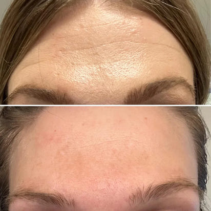Sephorin™ Peptide Lifting Ampoule